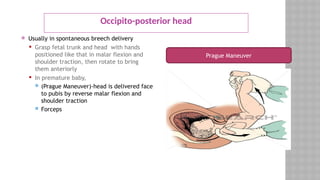 Occipito-posterior head
 Usually in spontaneous breech delivery
 Grasp fetal trunk and head with hands
positioned like that in malar flexion and
shoulder traction, then rotate to bring
them anteriorly
 In premature baby,
 (Prague Maneuver)-head is delivered face
to pubis by reverse malar flexion and
shoulder traction
 Forceps
Prague Maneuver
 