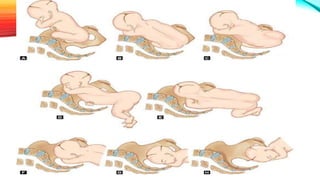 Breech delivery | PPTX