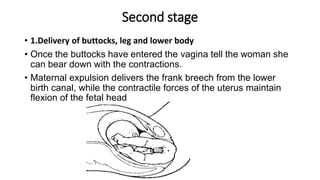 BREECH DELIVERY By Odokoyero Abdalah Fadhil and Nanfuka Mariam | PPTX
