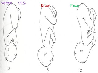 Vertex 99%
Face
Brow
11
 