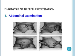 DIAGNOSIS OF BREECH PRESENTATION
1. Abdominal examination
24
 