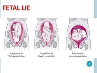 FETAL LIE
6
 