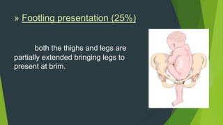 » Footling presentation (25%)


       both the thighs and legs are
partially extended bringing legs to
present at brim.
 