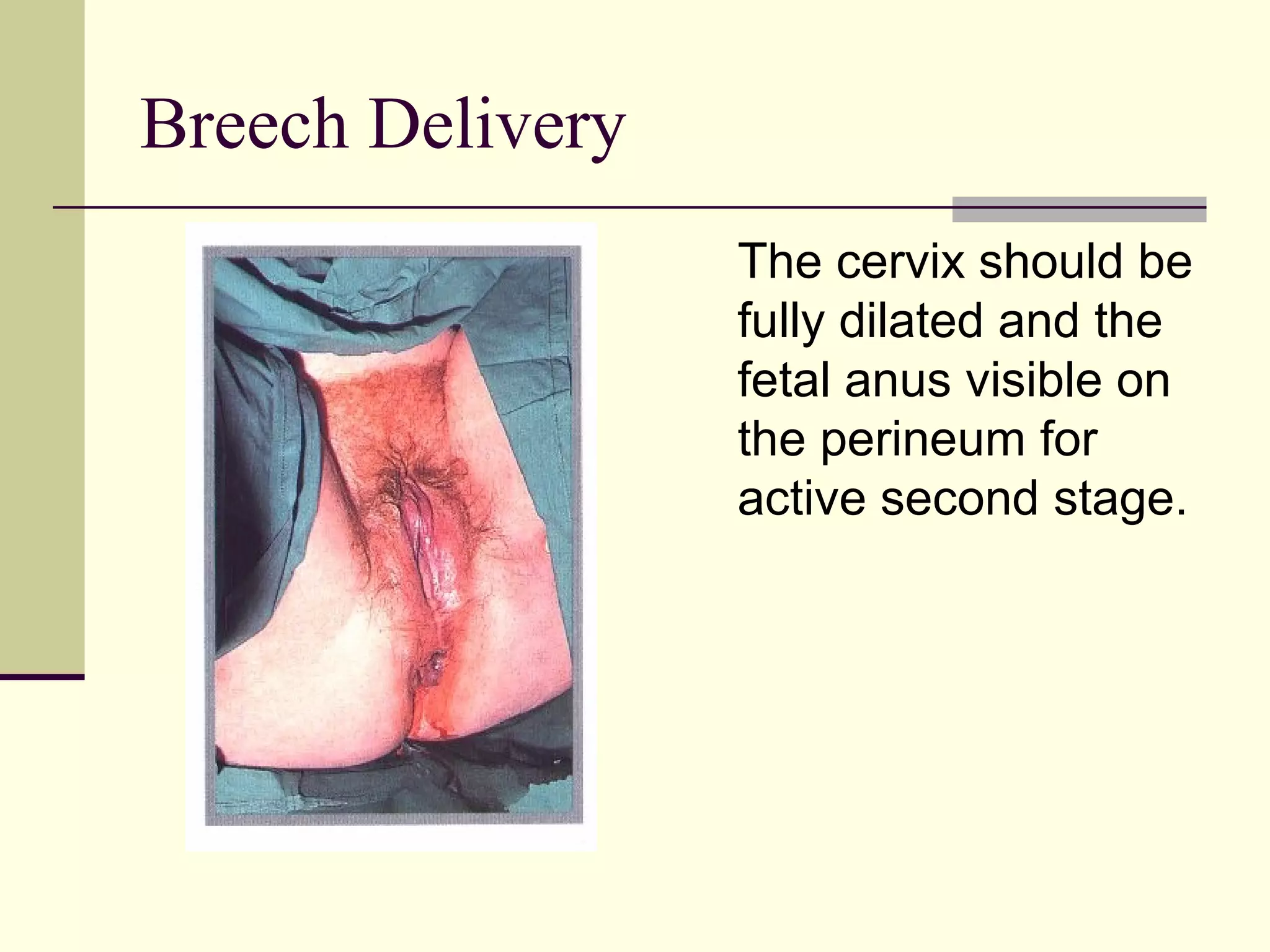 Breech Delivery
                  The cervix should be
                  fully dilated and the
                  fetal anus visible on
                  the perineum for
                  active second stage.
 