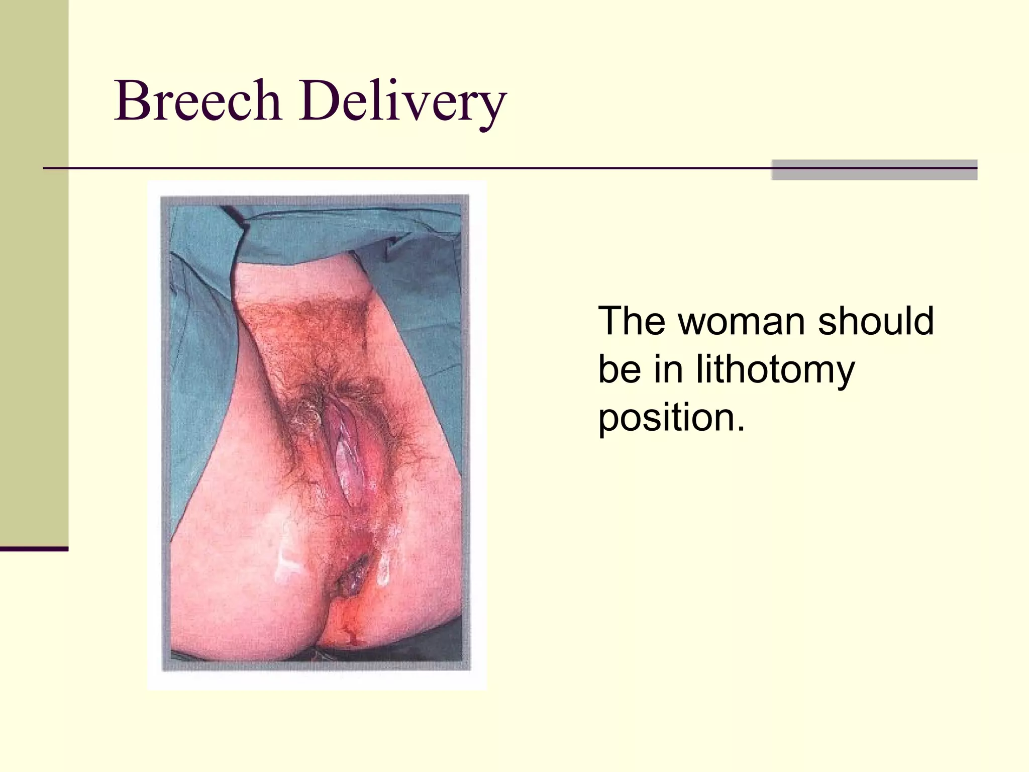 Breech Delivery


                  The woman should
                  be in lithotomy
                  position.
 