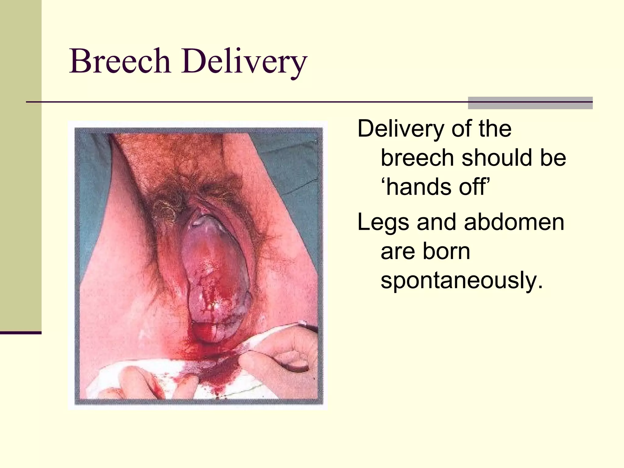 Breech Delivery
                  Delivery of the
                    breech should be
                    ‘hands off’
                  Legs and abdomen
                    are born
                    spontaneously.
 