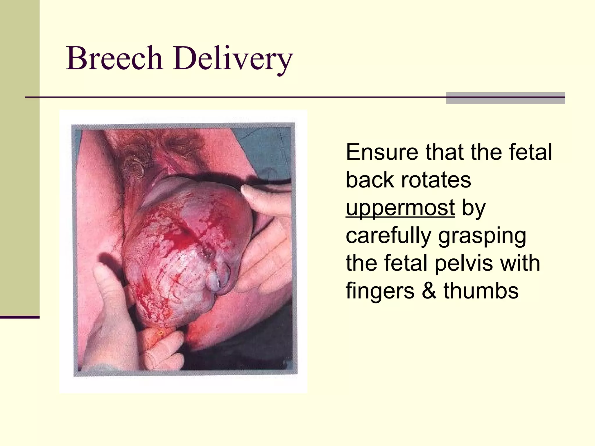 Breech Delivery

                  Ensure that the fetal
                  back rotates
                  uppermost by
                  carefully grasping
                  the fetal pelvis with
                  fingers & thumbs
 