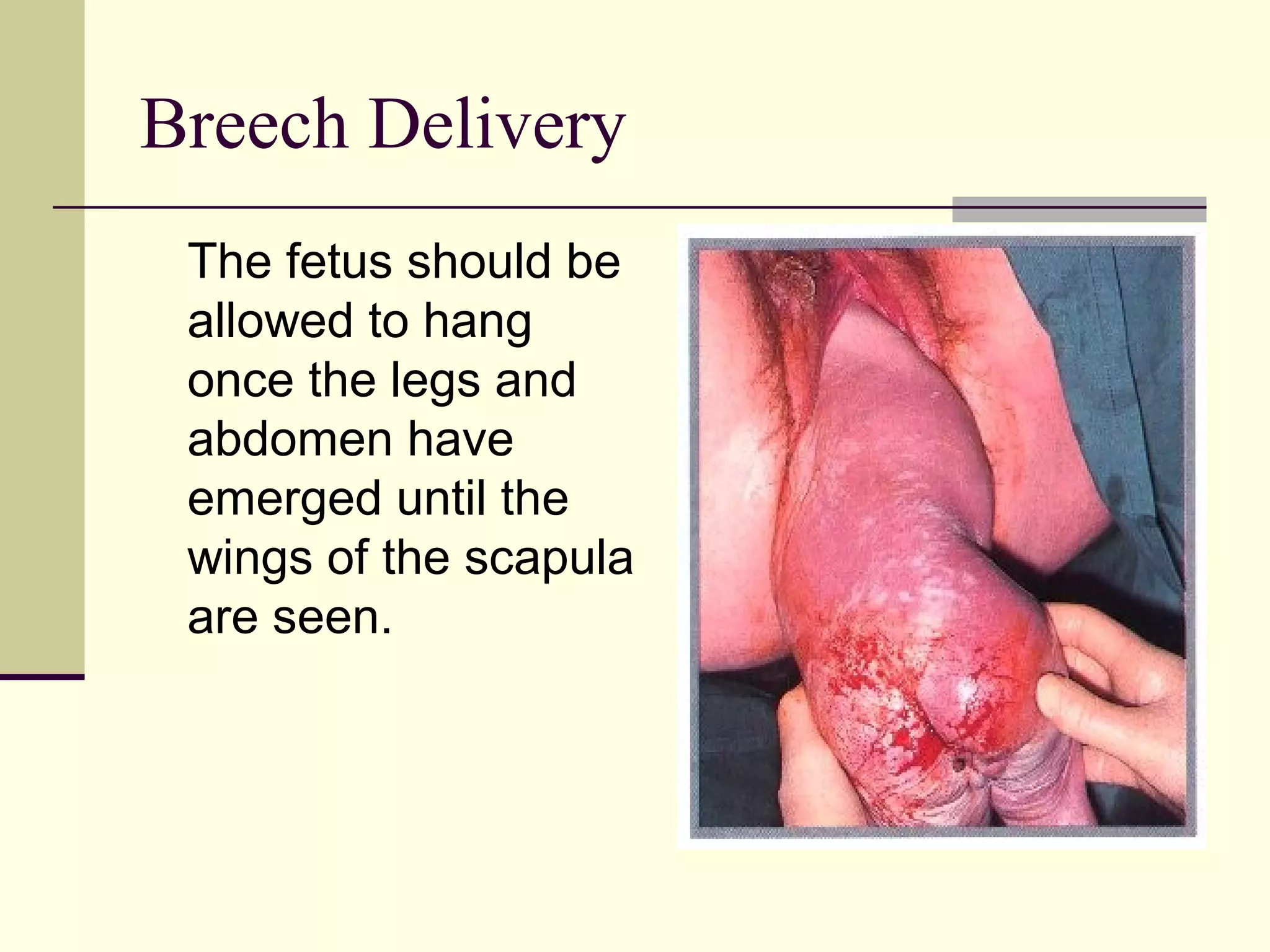 Breech Delivery
 The fetus should be
 allowed to hang
 once the legs and
 abdomen have
 emerged until the
 wings of the scapula
 are seen.
 