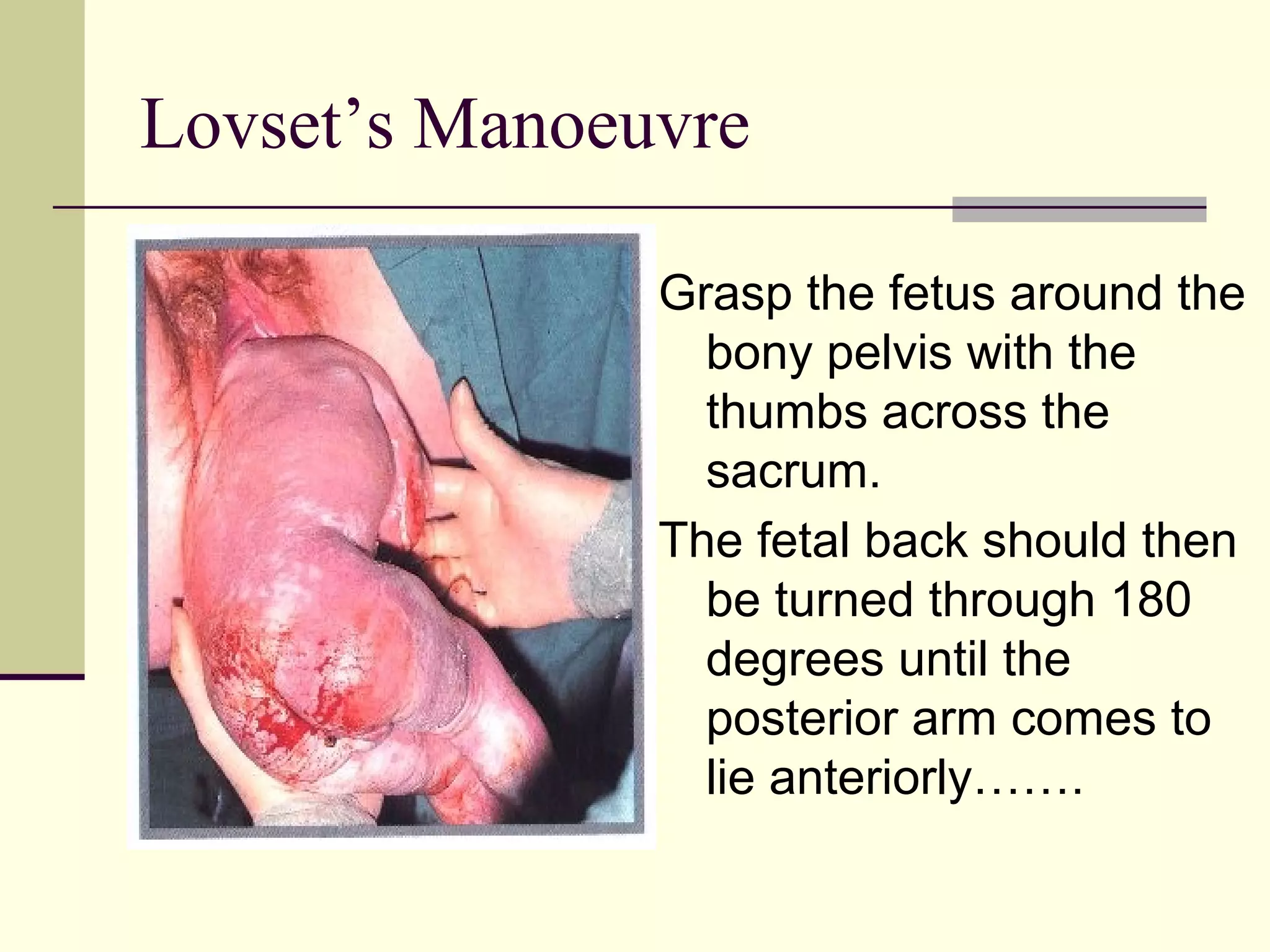 Lovset’s Manoeuvre

               Grasp the fetus around the
                 bony pelvis with the
                 thumbs across the
                 sacrum.
               The fetal back should then
                 be turned through 180
                 degrees until the
                 posterior arm comes to
                 lie anteriorly…….
 
