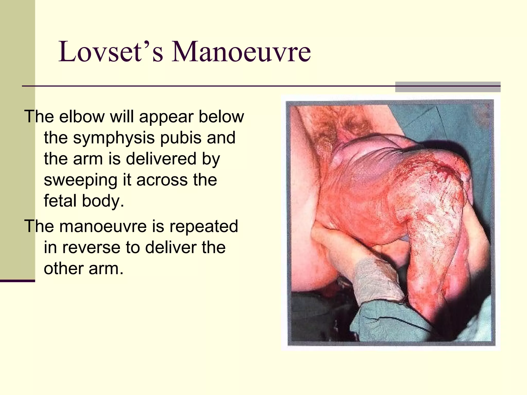 Lovset’s Manoeuvre
The elbow will appear below
  the symphysis pubis and
  the arm is delivered by
  sweeping it across the
  fetal body.
The manoeuvre is repeated
  in reverse to deliver the
  other arm.
 
