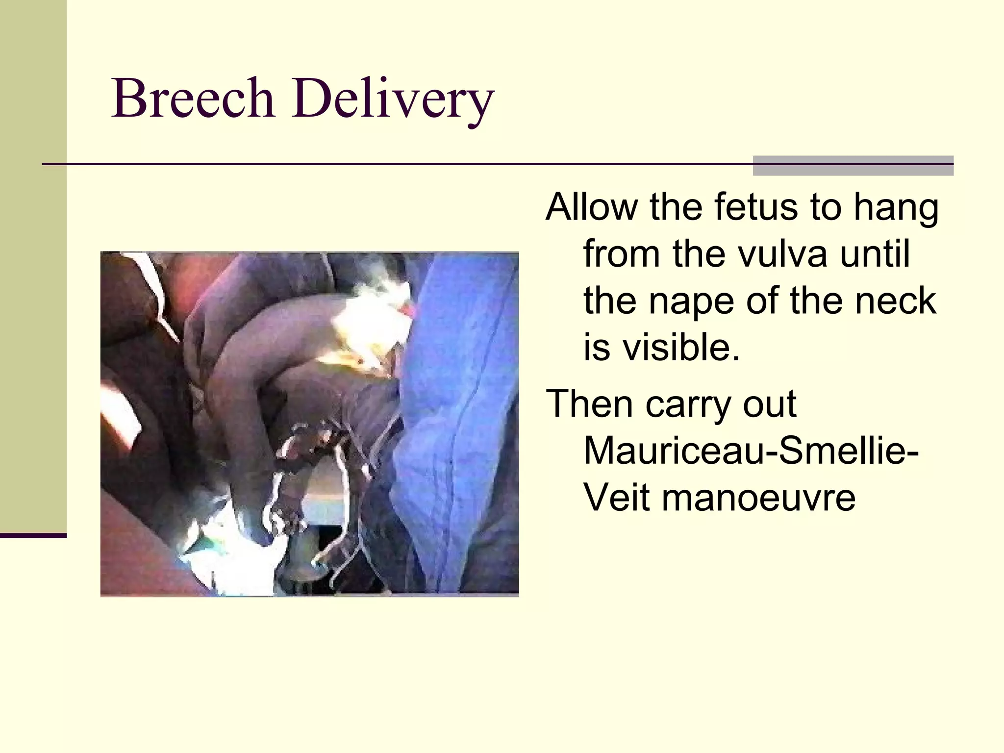Breech Delivery
                  Allow the fetus to hang
                    from the vulva until
                    the nape of the neck
                    is visible.
                  Then carry out
                    Mauriceau-Smellie-
                    Veit manoeuvre
 