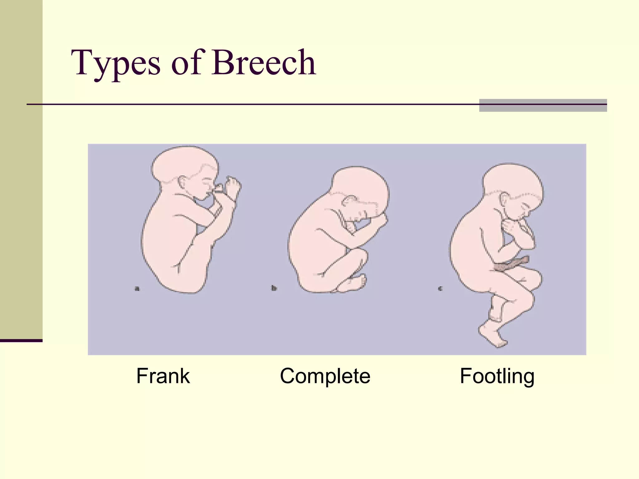 Types of Breech




    Frank   Complete   Footling
 