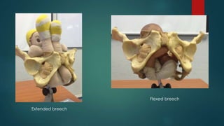 Extended breech
Flexed breech
 