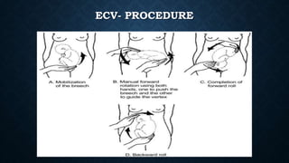 Breech presentation | PPTX