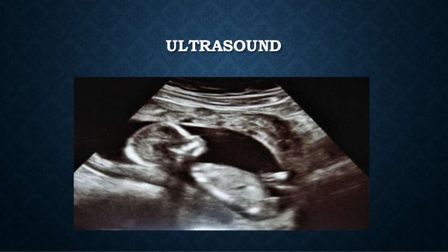 Breech Presentation Mode Of Delivery