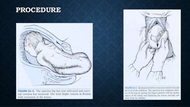 Breech presentation