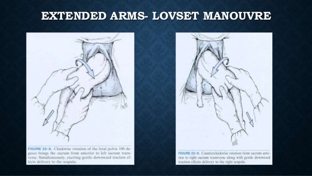 Breech presentation