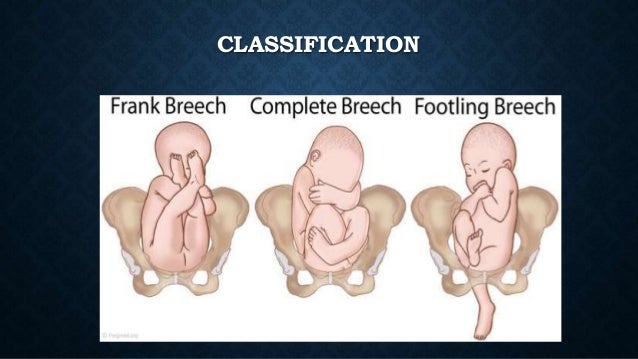 breech presentation anatomy definition