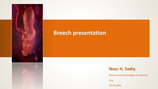 Breech presentation
Noor H. Sadiq
Wasit university/college of medicine
Iraq
10-10-2016
 