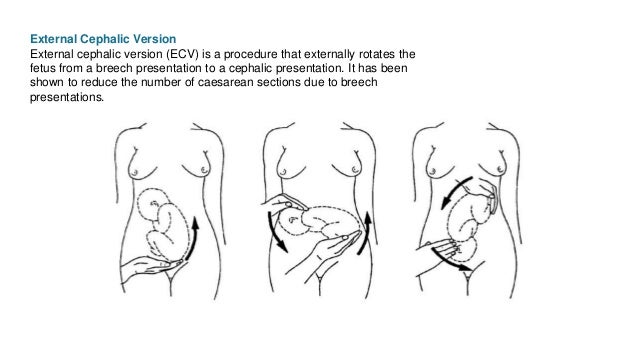 Breech Presentation positions-of-uterus-cartoon-vector-cartoondealer-35980715