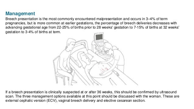 How to turn baby from breech position image