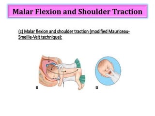 Malar Flexion and Shoulder Traction
 