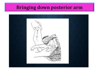 Bringing down posterior arm
 