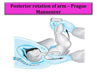 Posterior rotation of arm – Prague
Manoeuver
 