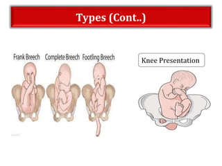 Types (Cont..)
Knee Presentation
 