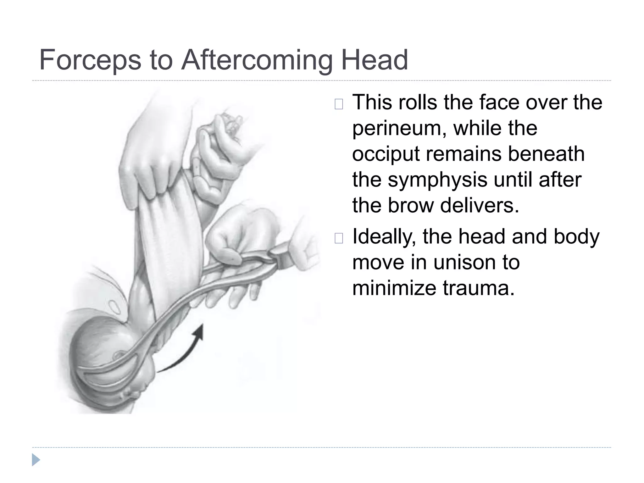 breech presentation.pptx