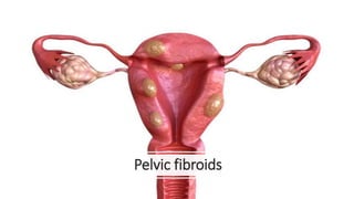 Pelvic fibroids
 