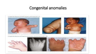 Congenital anomalies
 