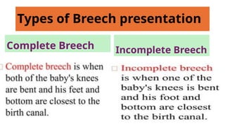 Breech Presentation.@12245775_+(£&_+:+&'--+ | PPTX
