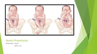 Breech Presentation.pdf DIPHU MEDICAL COLLEGE AND HOSPITAL | PDF