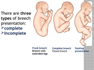 Breech presentation- gyanecology 6 (1).pptx
