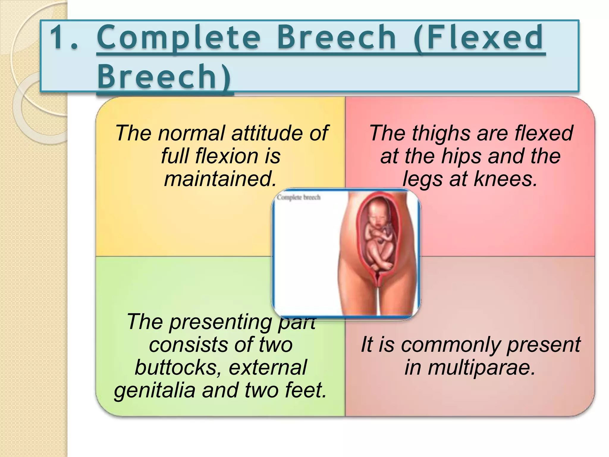 Breech presentation | PPTX