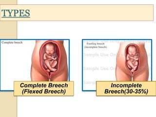 TYPES 
Complete Breech 
(Flexed Breech) 
Incomplete 
Breech(30-35%) 
 