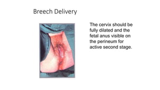Breech Delivery
The cervix should be
fully dilated and the
fetal anus visible on
the perineum for
active second stage.
 