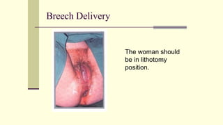 Breech Delivery
The woman should
be in lithotomy
position.
 