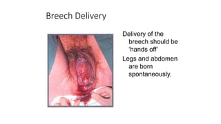Breech Delivery
Delivery of the
breech should be
‘hands off’
Legs and abdomen
are born
spontaneously.
 