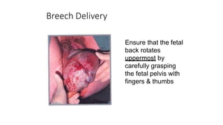 Breech Delivery
Ensure that the fetal
back rotates
uppermost by
carefully grasping
the fetal pelvis with
fingers & thumbs
 