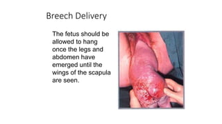 Breech Delivery
The fetus should be
allowed to hang
once the legs and
abdomen have
emerged until the
wings of the scapula
are seen.
 