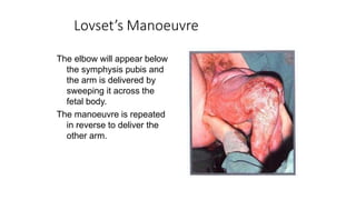 Lovset’s Manoeuvre
The elbow will appear below
the symphysis pubis and
the arm is delivered by
sweeping it across the
fetal body.
The manoeuvre is repeated
in reverse to deliver the
other arm.
 