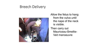 Breech Delivery
Allow the fetus to hang
from the vulva until
the nape of the neck
is visible.
Then carry out
Mauriceau-Smellie-
Veit manoeuvre
 