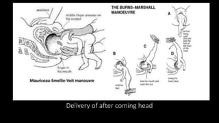 Delivery of after coming head
 