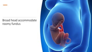Broad head accommodate
roomy fundus
 