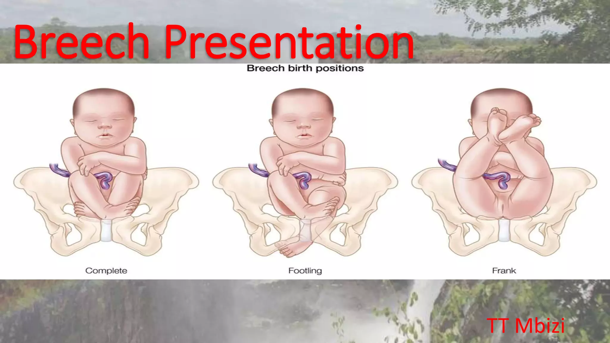 Breech presentation [autosaved] | PPTX