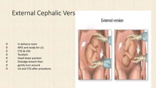 External Cephalic Version
In delivery room
NPO and ready for c/s
CTG & USS
Tocolytic
Head down position
Dislodge breech then
gently turn around
US and CTG after procedure.
 