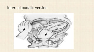 Internal podalic version
 