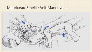 Mauriceau-Smellie-Veit Maneuver
 
